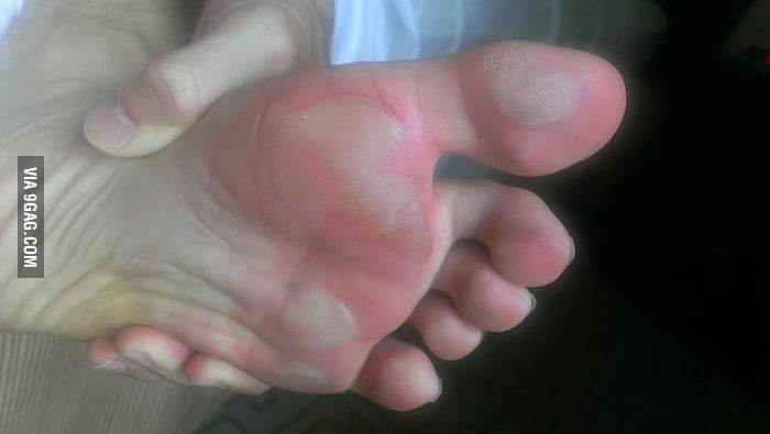 barefoot on treadmill