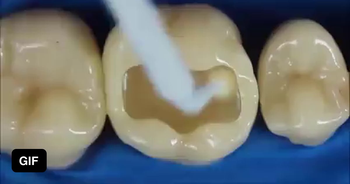 Dental composite resins allow for the seamless repair of a large hole in a tooth 9GAG
