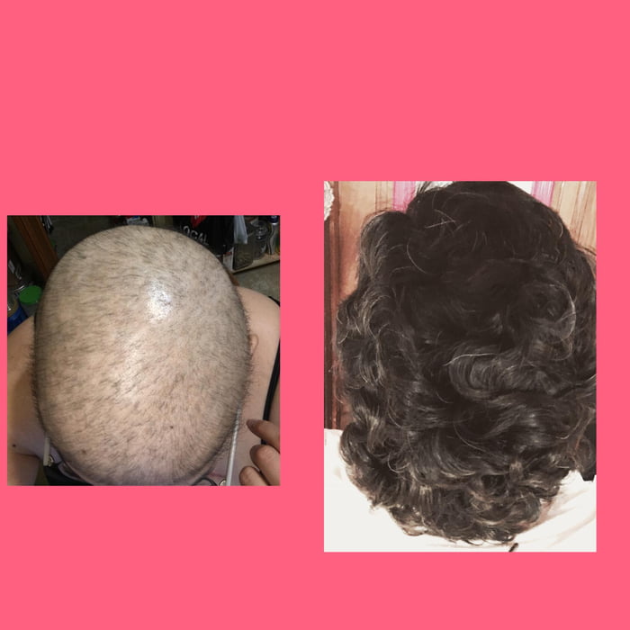 Hair Growth Progress 6 Months Post Chemo 9gag 2735