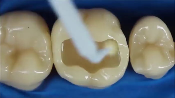 Dental composite resins allow for the seamless repair of a large hole in a tooth