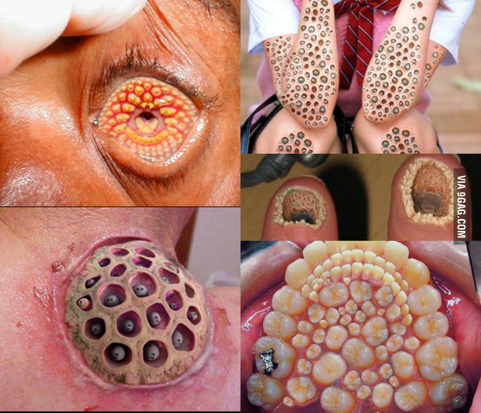 Congrats, you have trypophobia! 