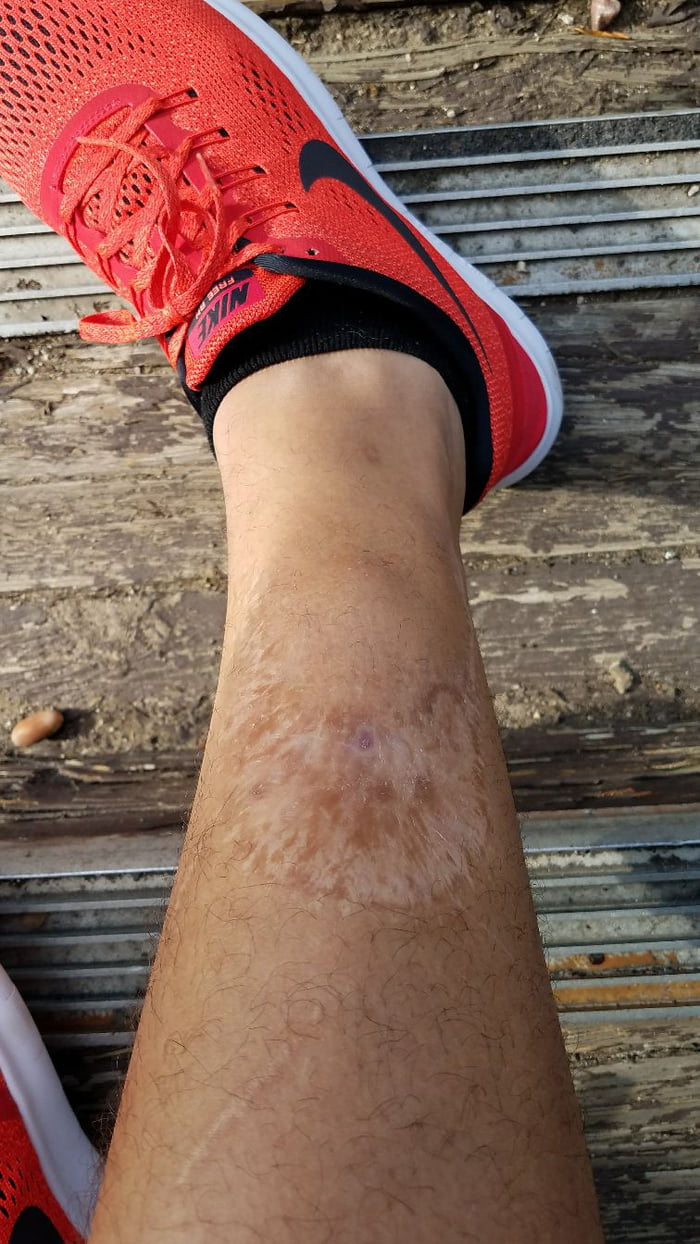 Have You Ever Seen The Scar Of A Shark Bite 9gag