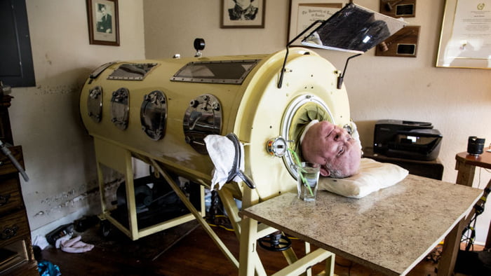Did Polio Inspire the Iron Lung?
