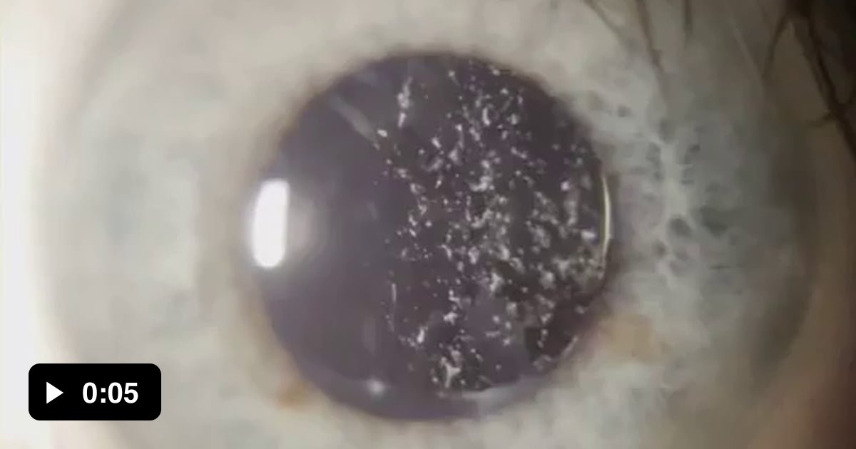 Asteroid hyalosis, a condition where calcium deposits float around in