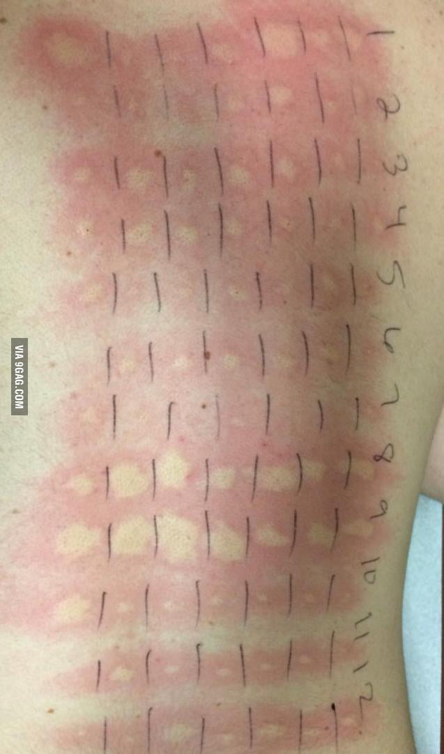 nearly-scored-a-perfect-score-on-my-allergy-test-9gag