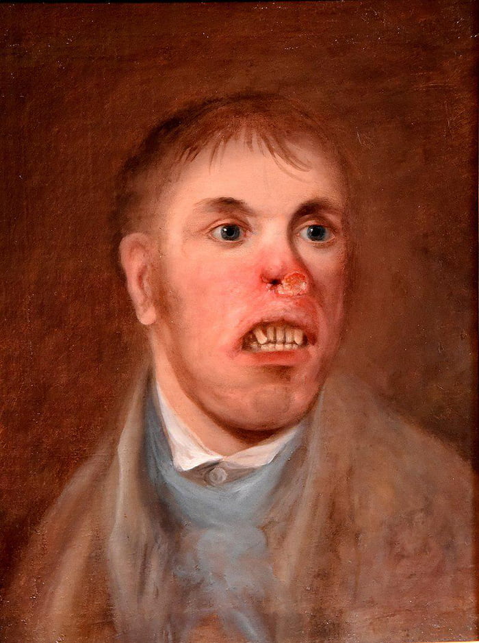 Portrait of a man affected with what is now believed to have been ...