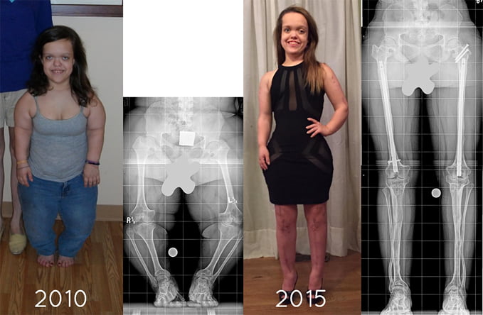 A Patient With Achondroplasia Dwarfism Before And After One Arm Lengthening And Two Leg 