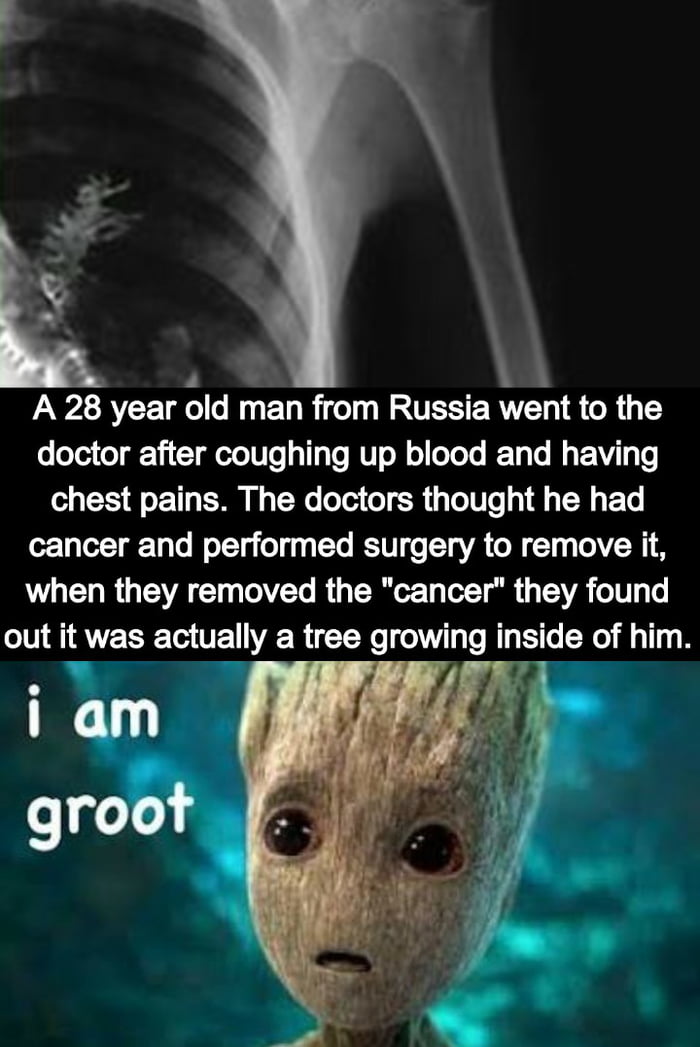 Chernobyl Chest X Ray When Someone Tells You He Didn T