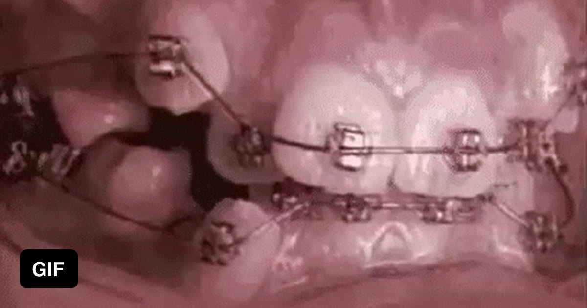 Braces mechanics 9GAG