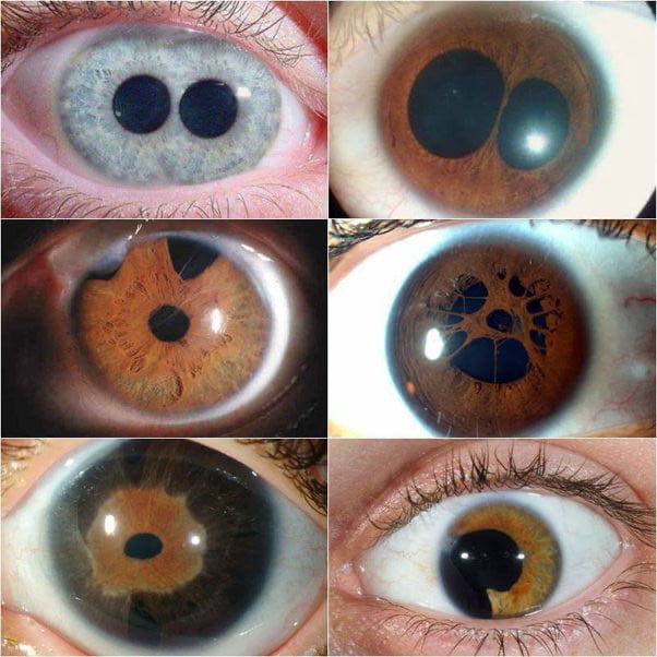 Diplocoria /Polycoria is a pathological condition of the eye ...