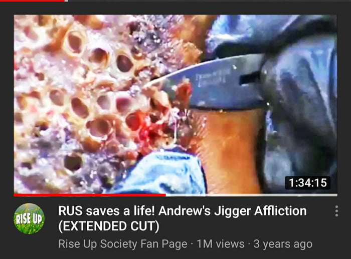 Has anyone else seen these jigger removal videos on YouTube? 