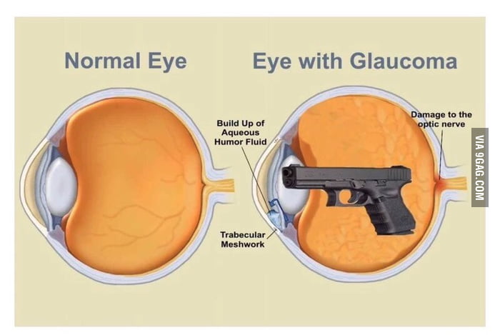 as-someone-with-glaucoma-i-can-confirm-this-9gag