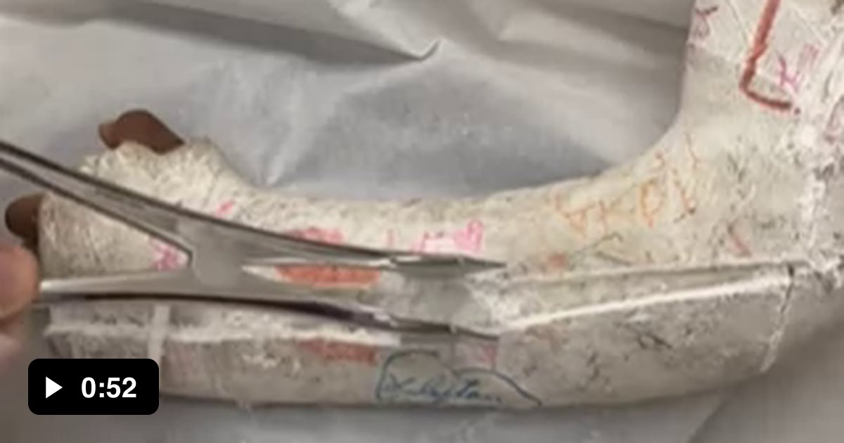 Cutting a cast open - 9GAG